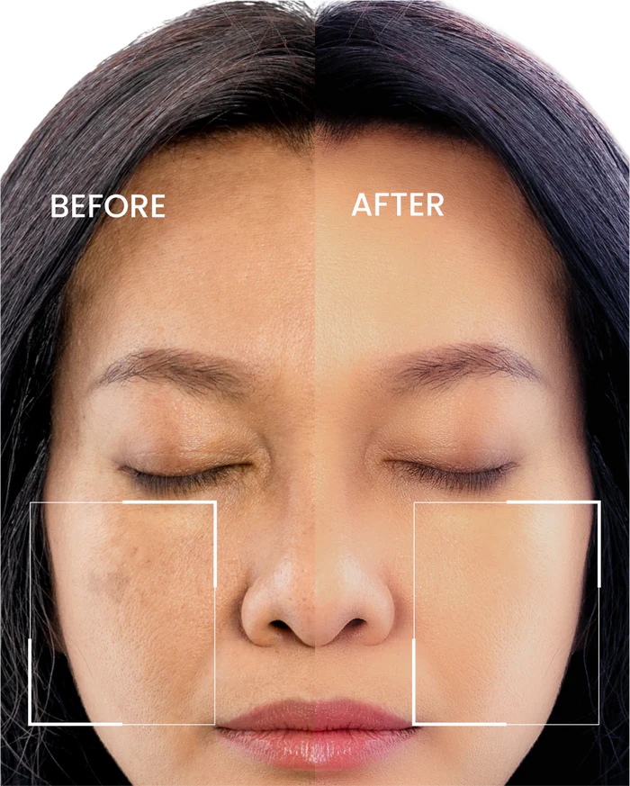 Dark Spot Corrector